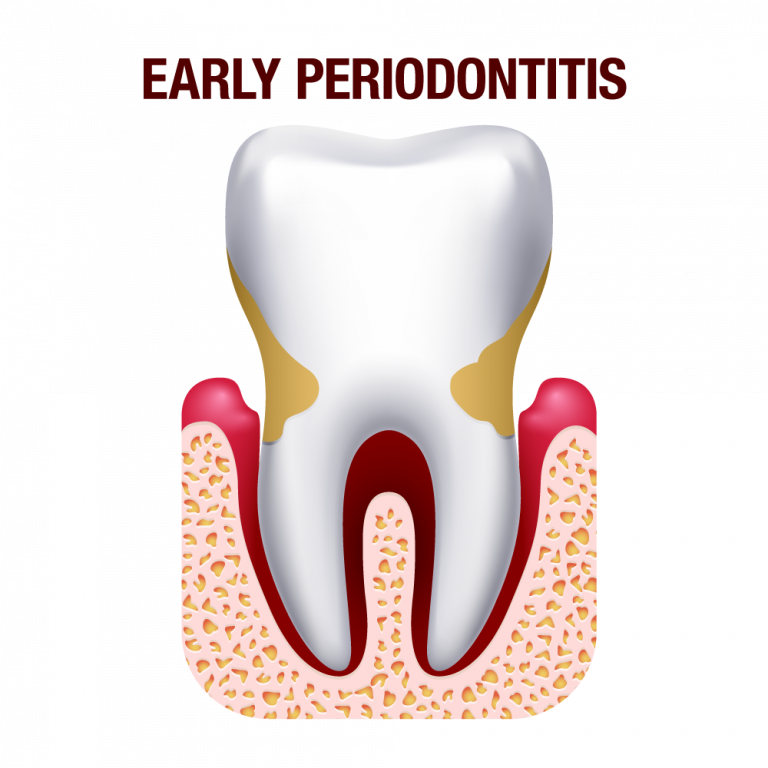Periodontitis London