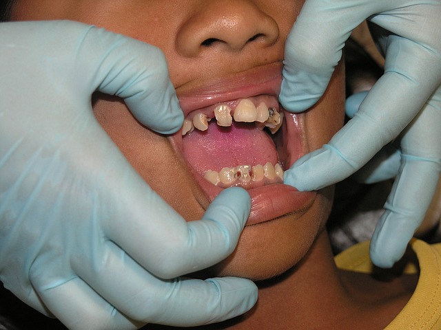 Rotten teeth