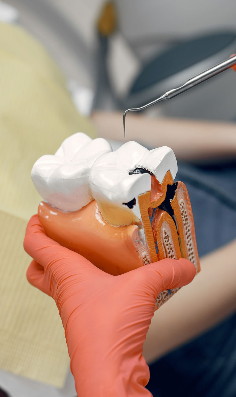 Temporary Filling | Emergency Dentist London