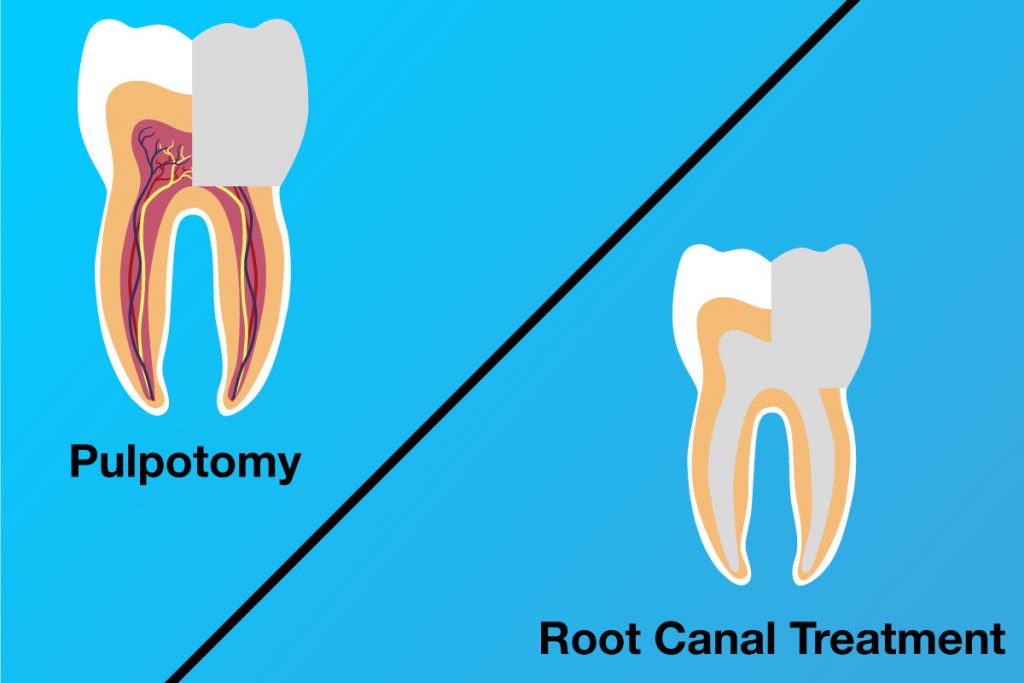 Pulpotomy-vs-Root-canal-treatment