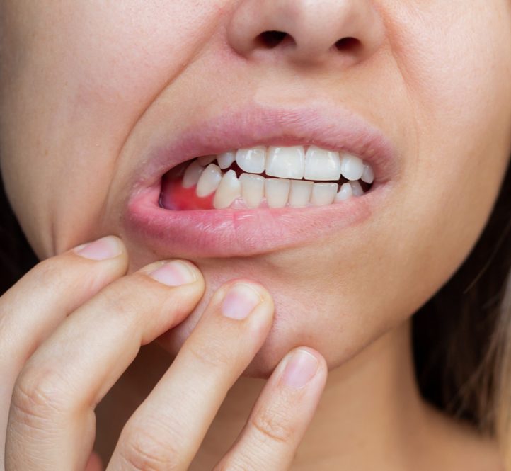 Symptoms of periodontitis