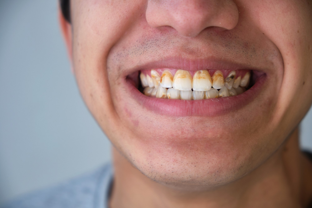 What causes periodontitis